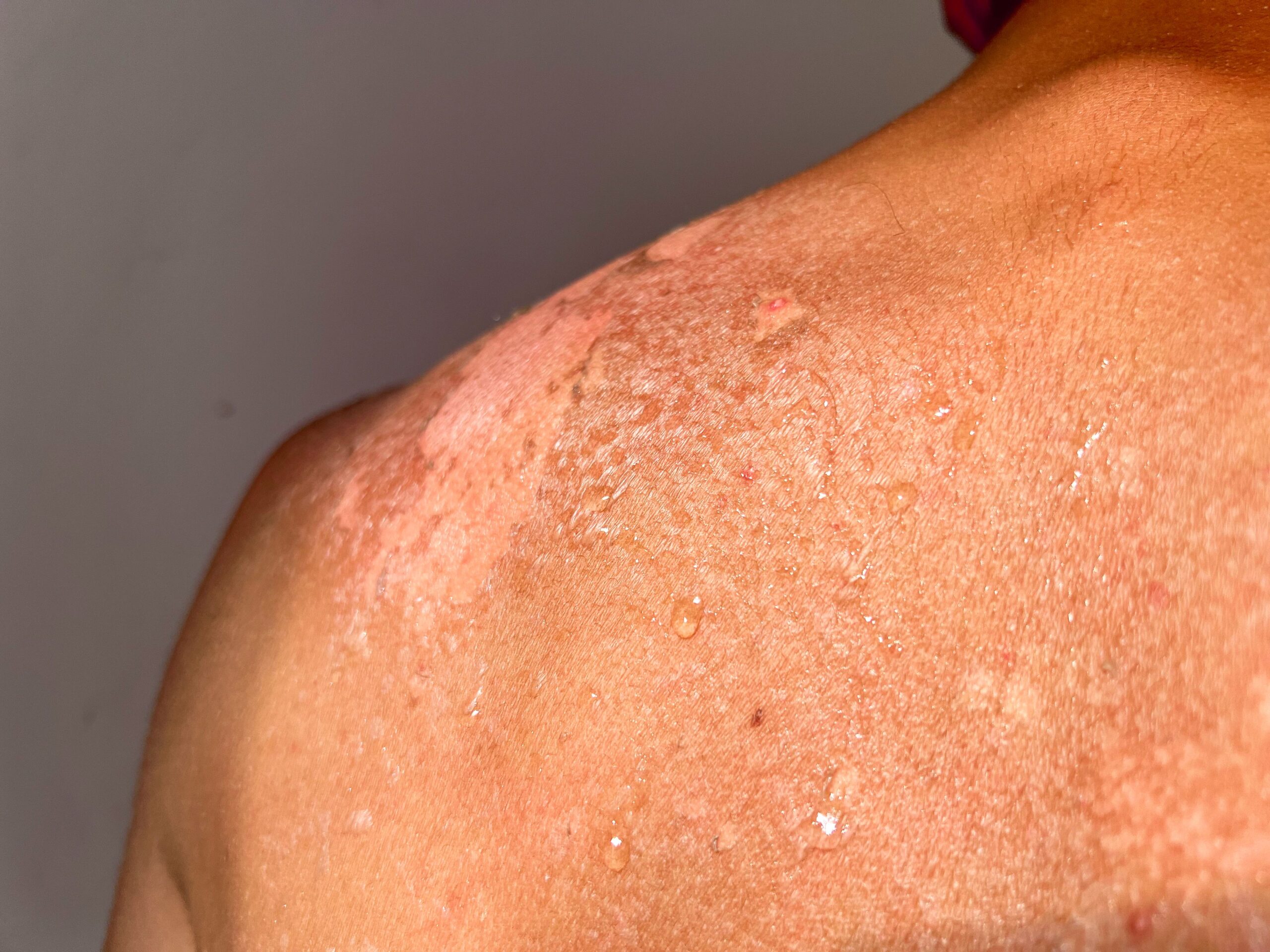 Rheuma, Psoriasis & Chronisch-entzündliche Darmerkrankungen​